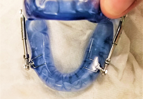 custom mouthguards in castro valley