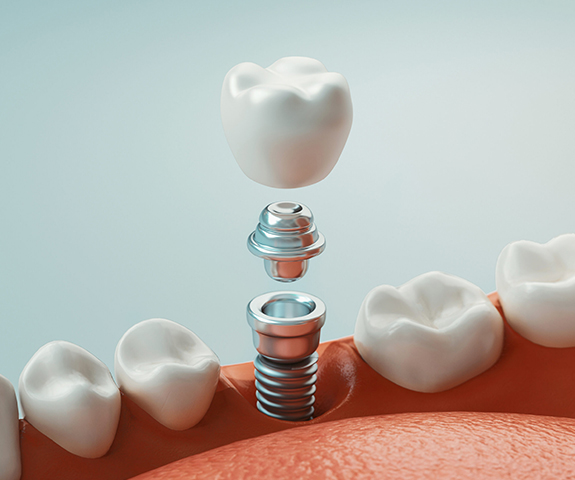 Dental Implants Treatment in Castro Valley