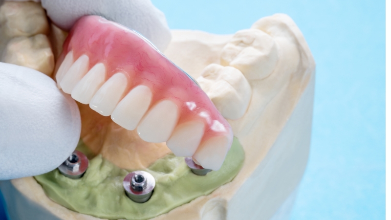 benefits of getting full mouth dental implants
