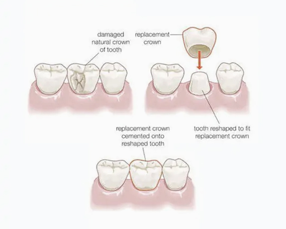 Porcelain Crowns And Bridges in Castro Valley CA