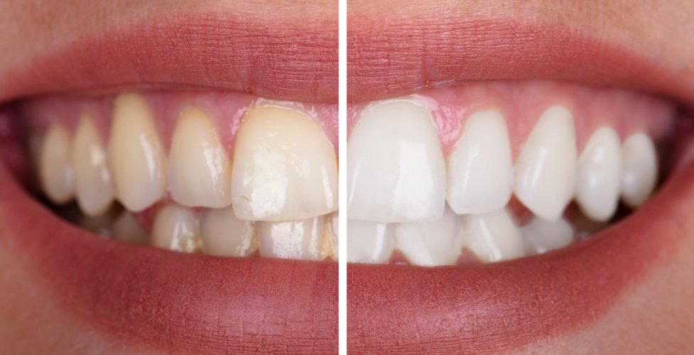 the truth behind common teeth whitening myths
