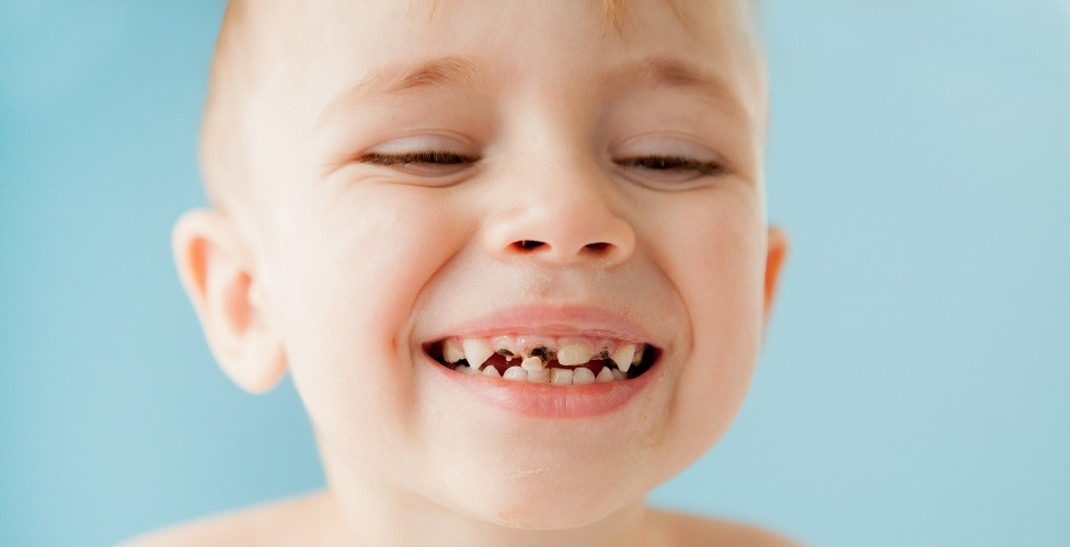 7 simple steps for new parents to stop baby bottle tooth decay