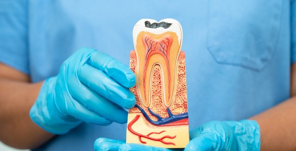 what happens if you get an infection after a root canal