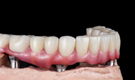 How to Clean All-on-4 Dental Implants?