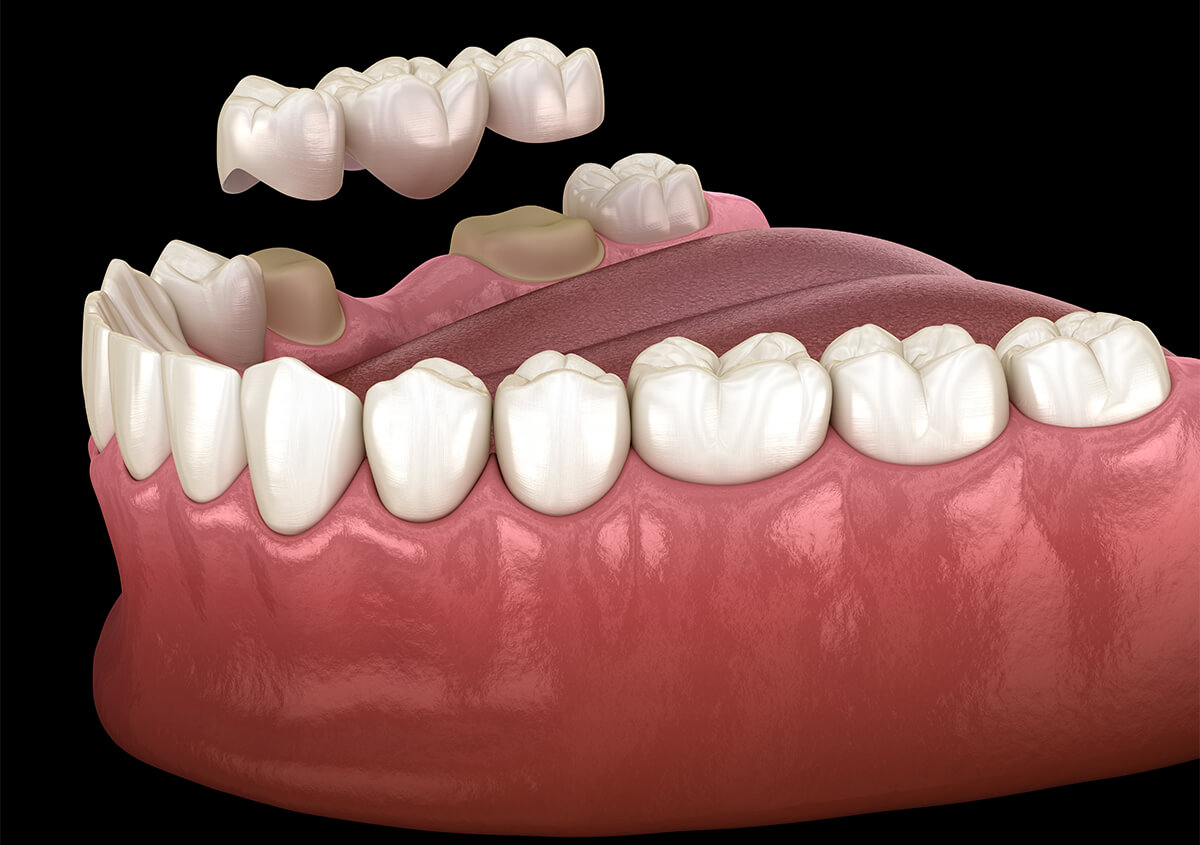 Replace Missing Teeth