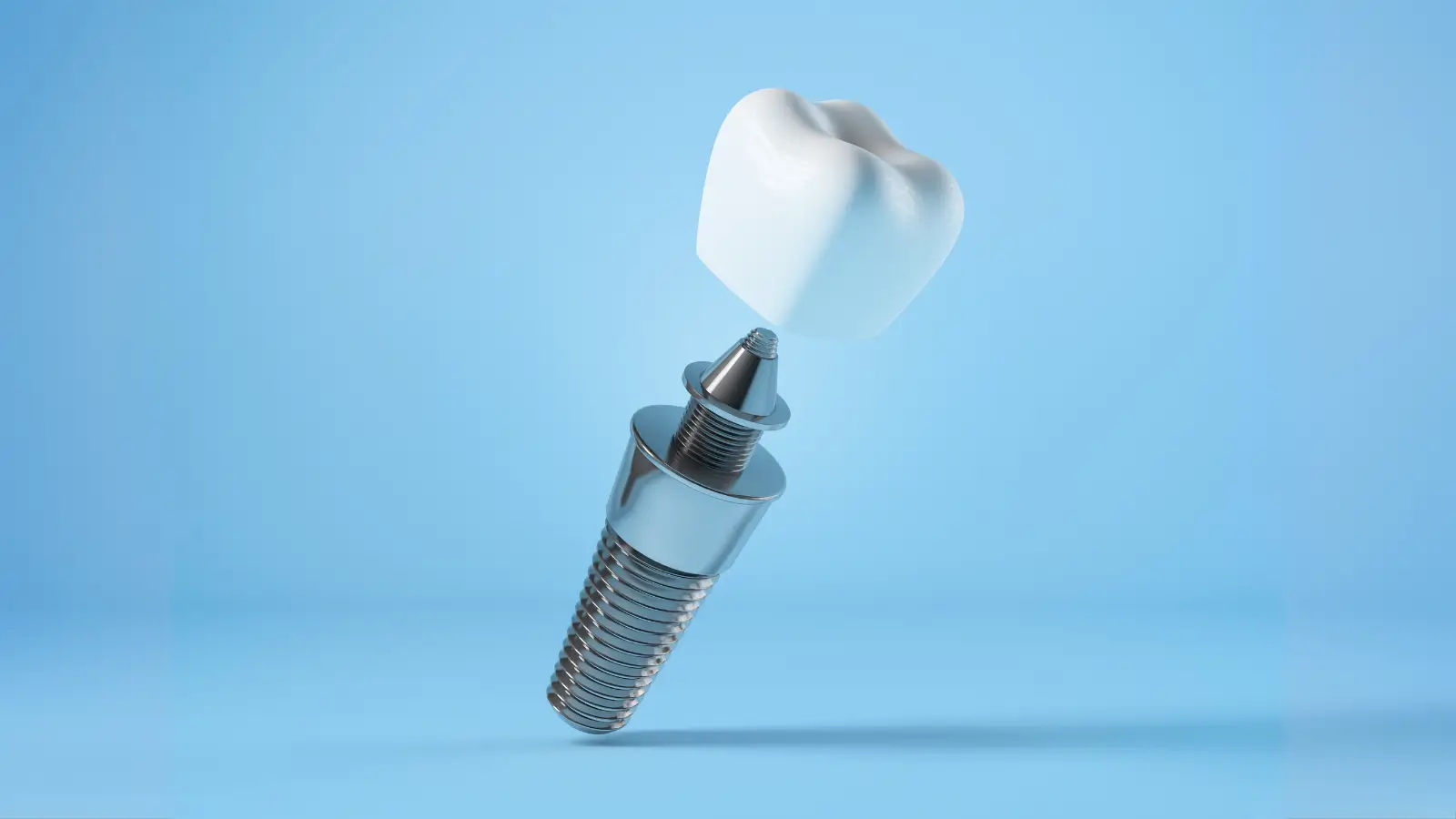 Is Dental Implant Treatment Worth It in Your 20s