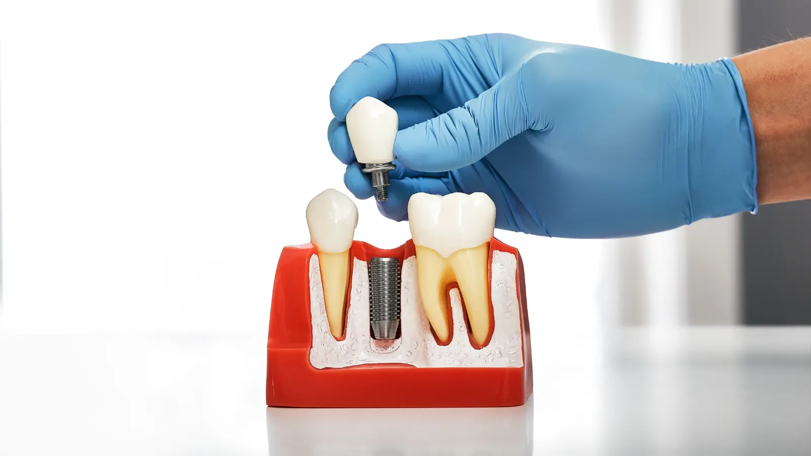 Dental Implant Placement Process
