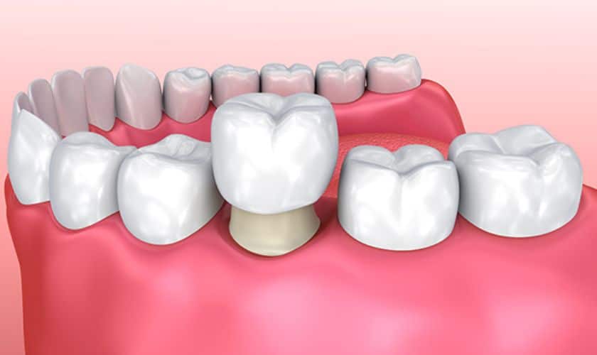 Dental Crowns in South Austin TX