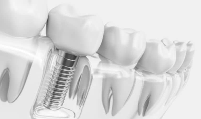 Dental Implants in South Austin TX