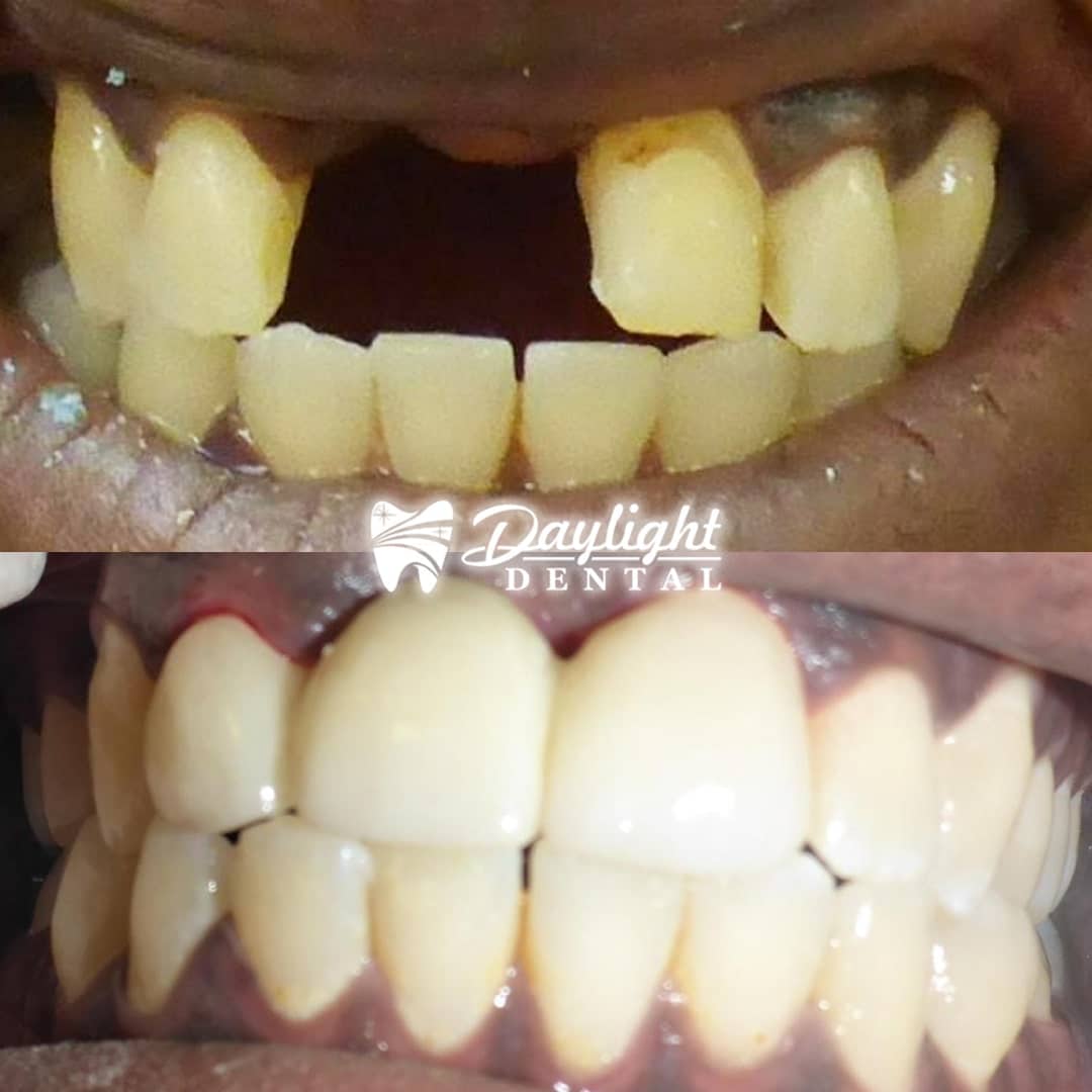 Before After Gallery-Dentist in Austin