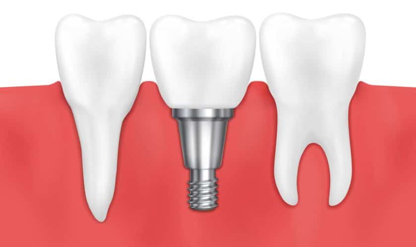 Dental Implants in South Austin TX