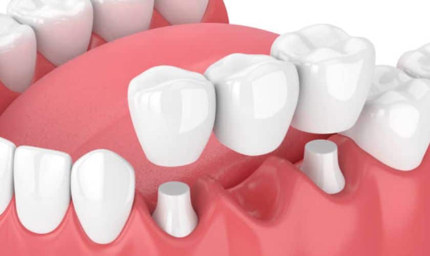 Dental Crowns in South Austin, TX