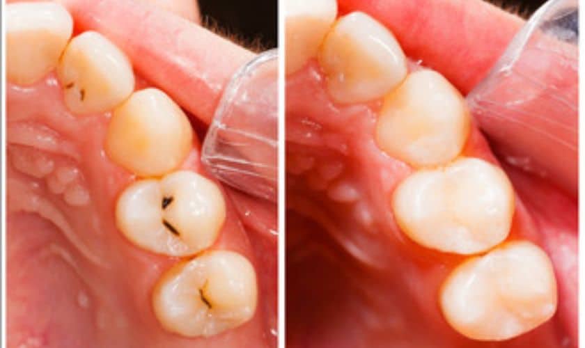 Root Canal in South Austin TX