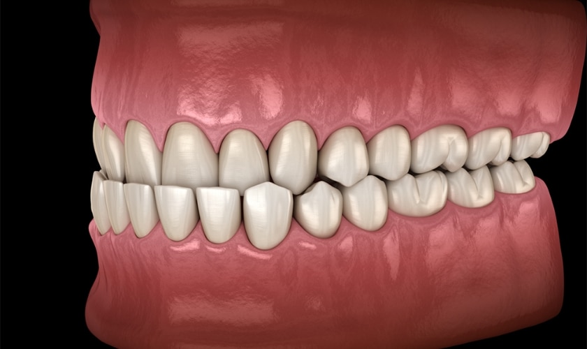 How To Fix An Underbite