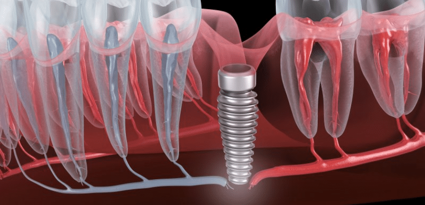 _Dental Implant Failure