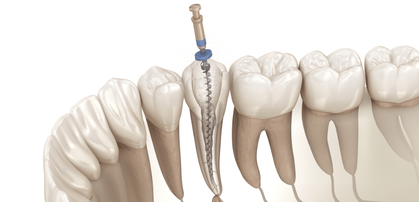 Do I Need a Root Canal