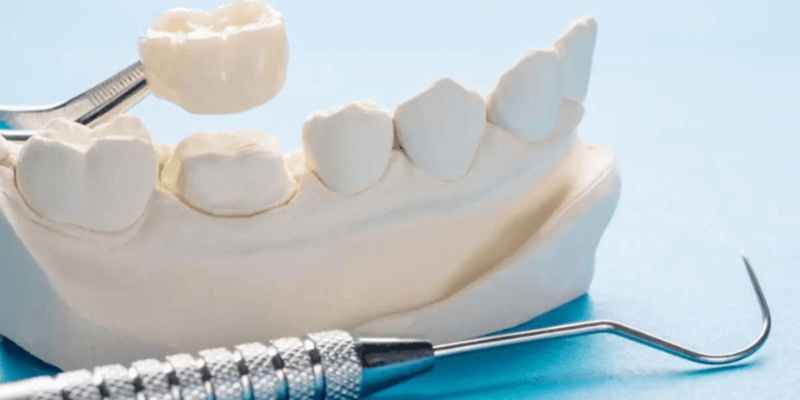 how long dental crowns last