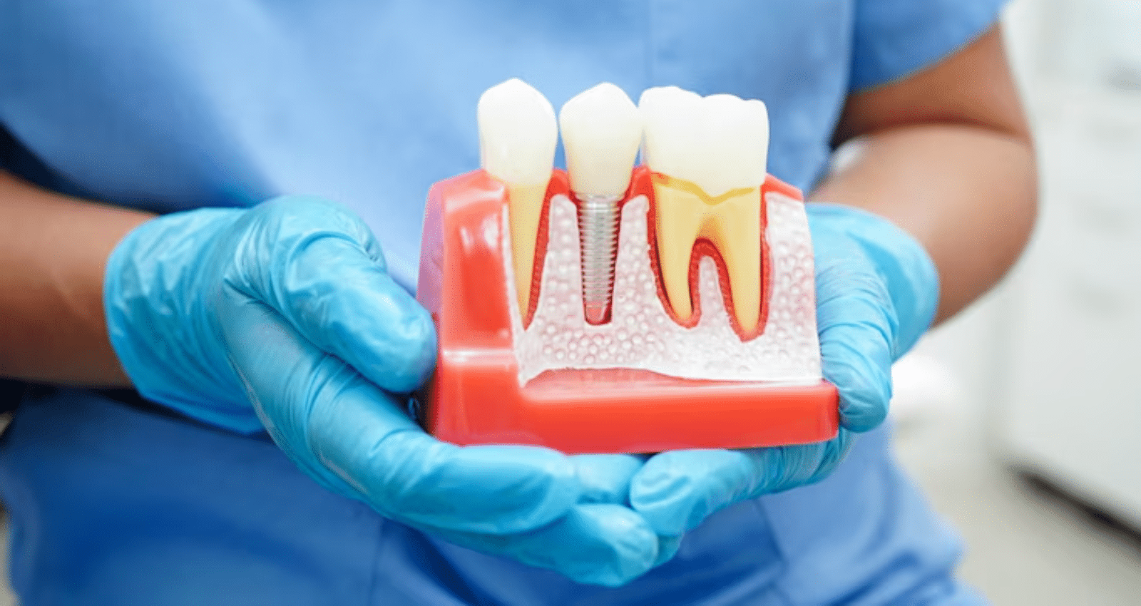top 5 mistakes to avoid after your dental implant procedure
