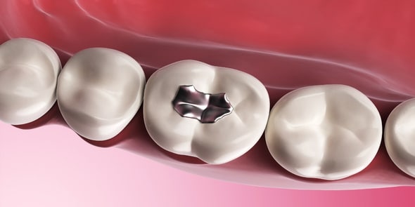 signs to replace your fillings