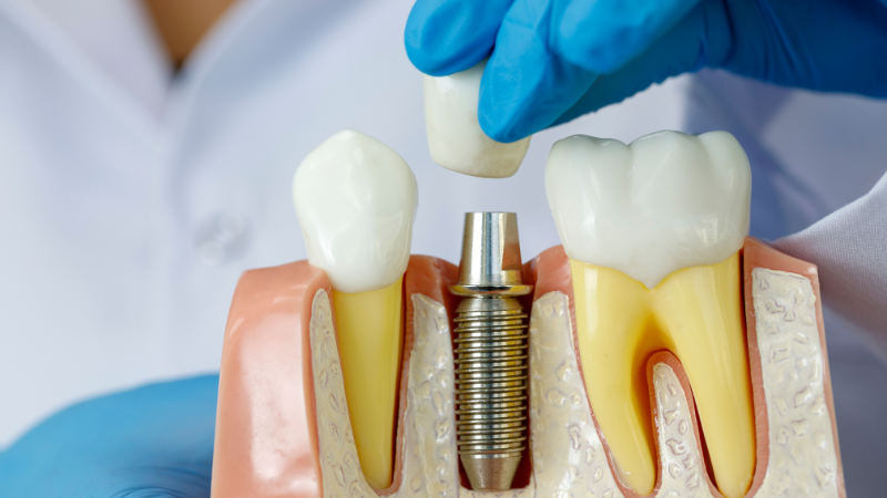 how to care for implants