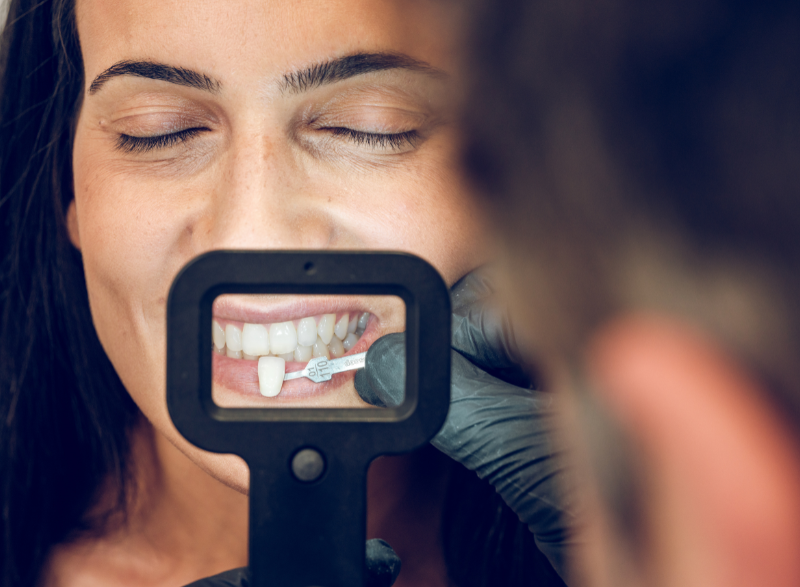 proper care and maintenance of dental veneers