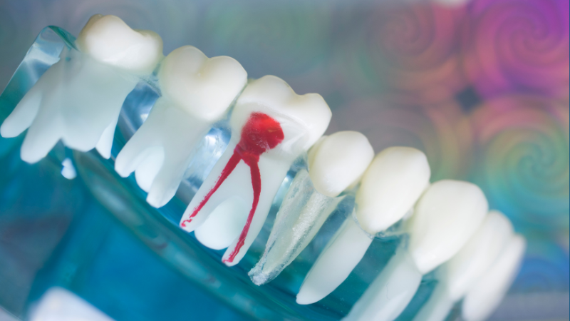 5 quick tips to help you recover faster after a root canal