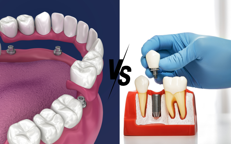 all-on-4 vs. traditional dental implants