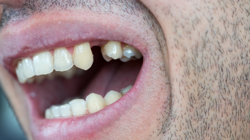 options for replacing a missing tooth