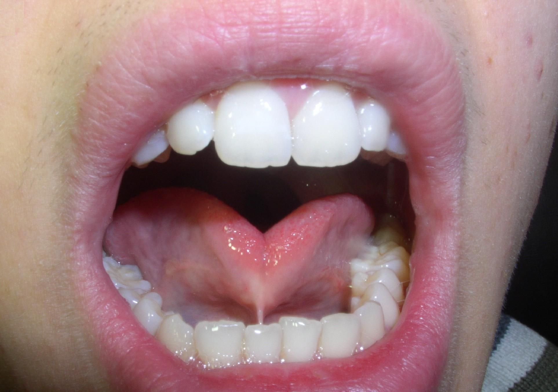 how does a tongue tie affect your pronunciation