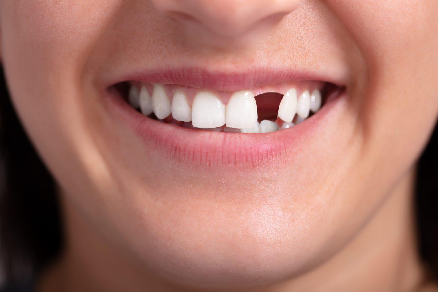 lose a tooth as an adult
