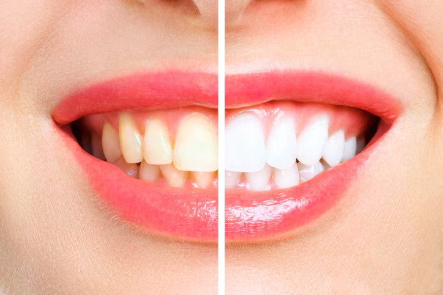 mistakes to avoid after teeth whitening