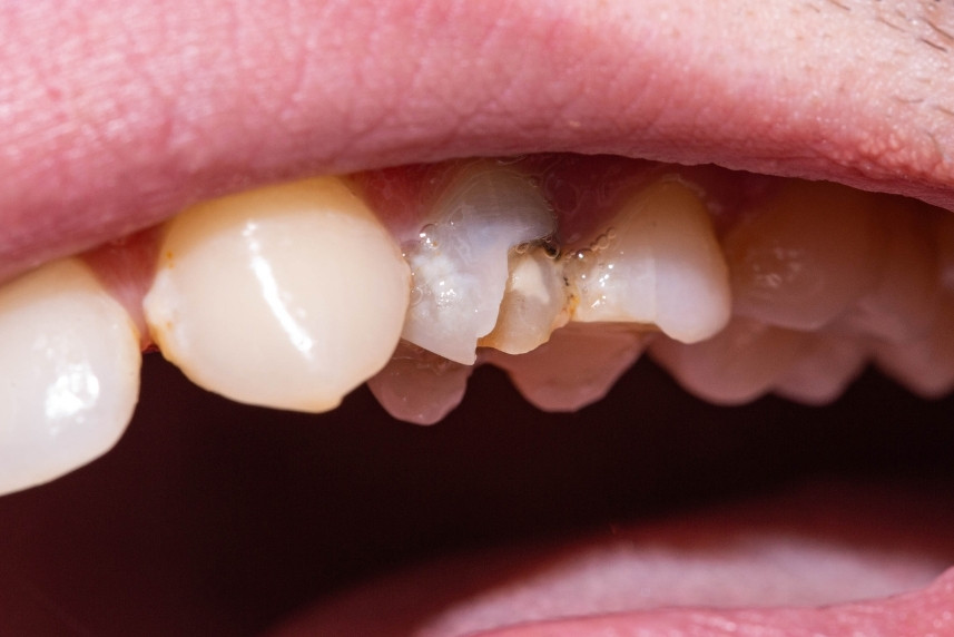 is a black tooth a dental emergency