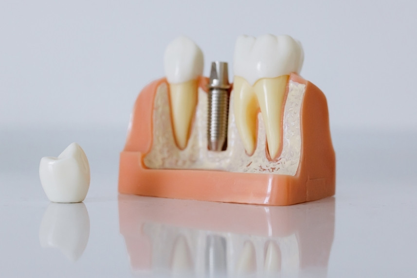 the impact of nutrition on dental implant healing and longevity