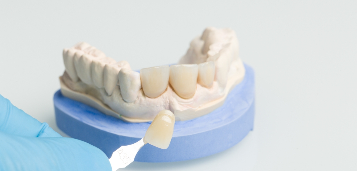 Veneers For A Vibrant New Year: Transform Your Smile In 2024