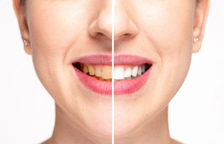 common whitening mistakes to avoid in kyle