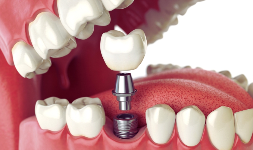you need to know about the 6 types of dental implants before choosing one