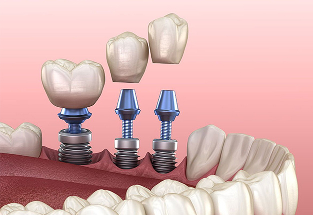 All-On-X Dental Implants In Rocklin CA