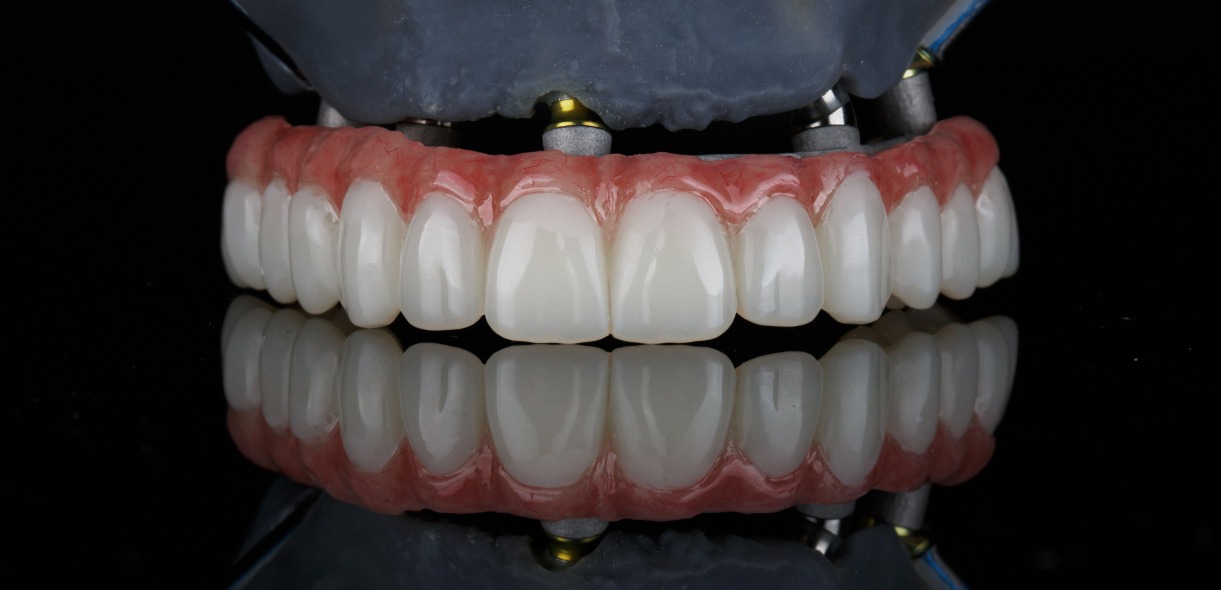 All-on-X Dental Implants Procedure