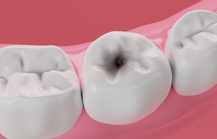 how dental cleanings reduce decay risks