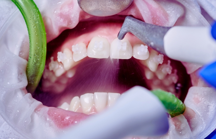 how dental cleanings reduce the risk of tooth decay