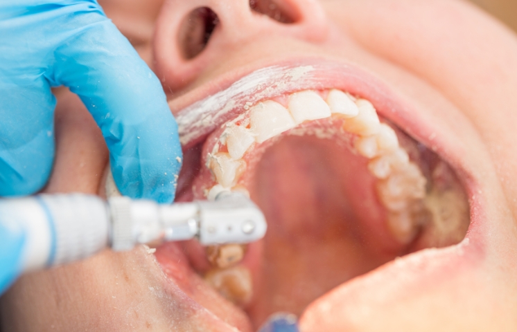 why some people need more frequent dental cleanings than others