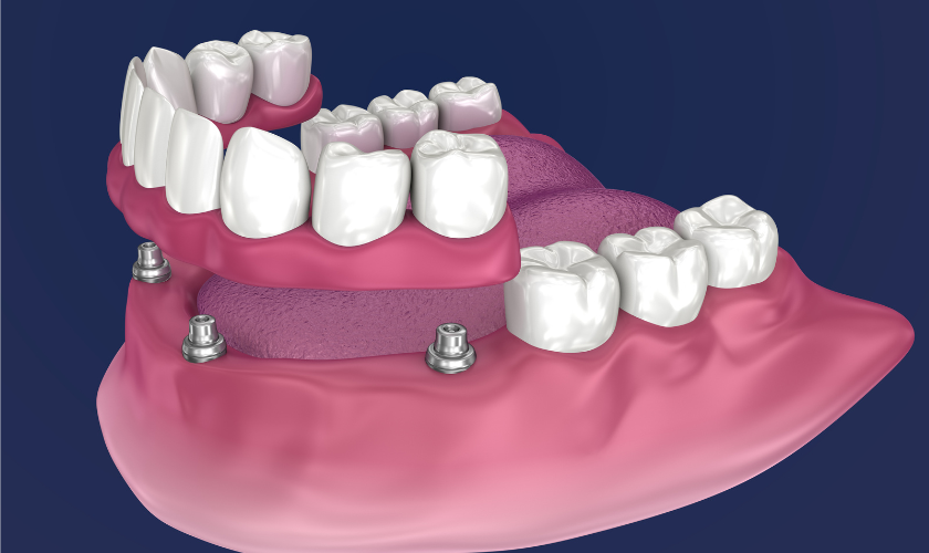 Featured image for “How to Choose the Right Dentures for Your Needs”