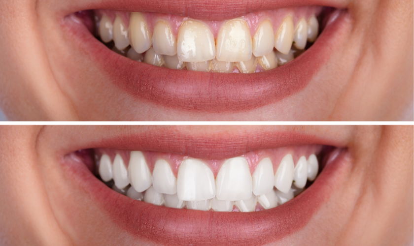 Featured image for “How Does Diet Affect the Effectiveness of Teeth Whitening?”