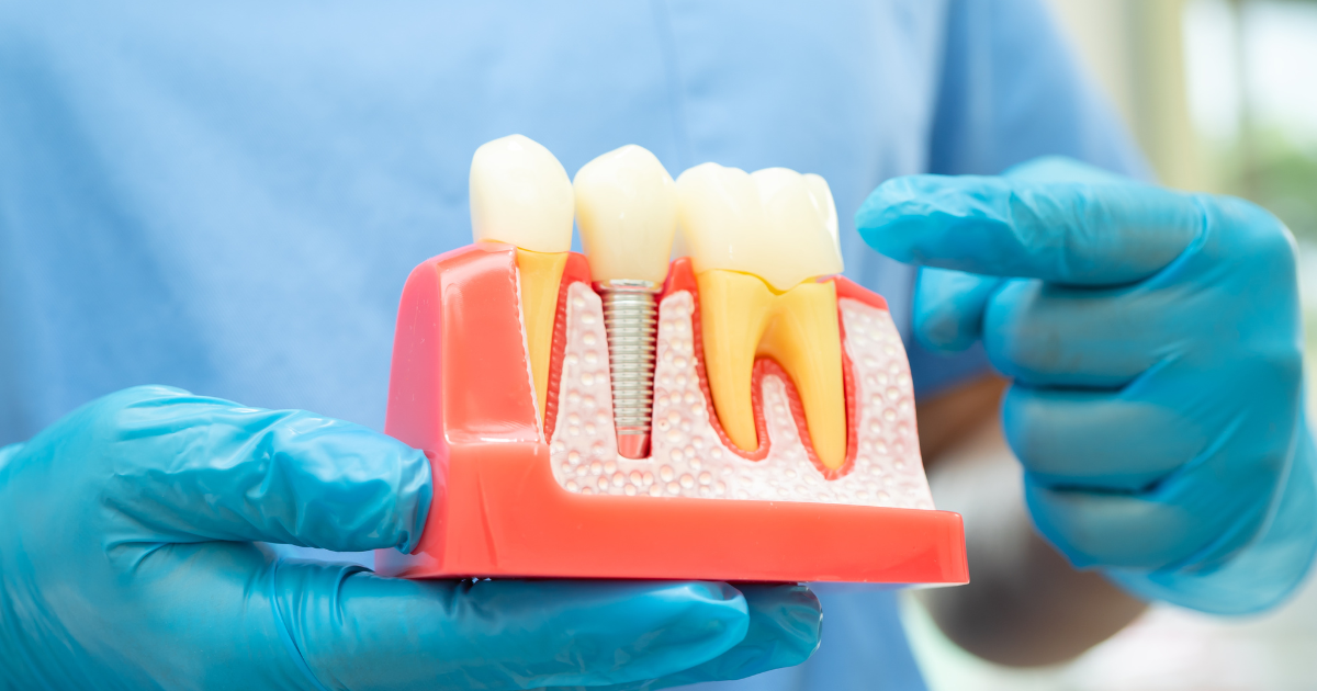 Featured image for “Can You Get Dental Implants If You Have Gum Disease? What You Need To Know”