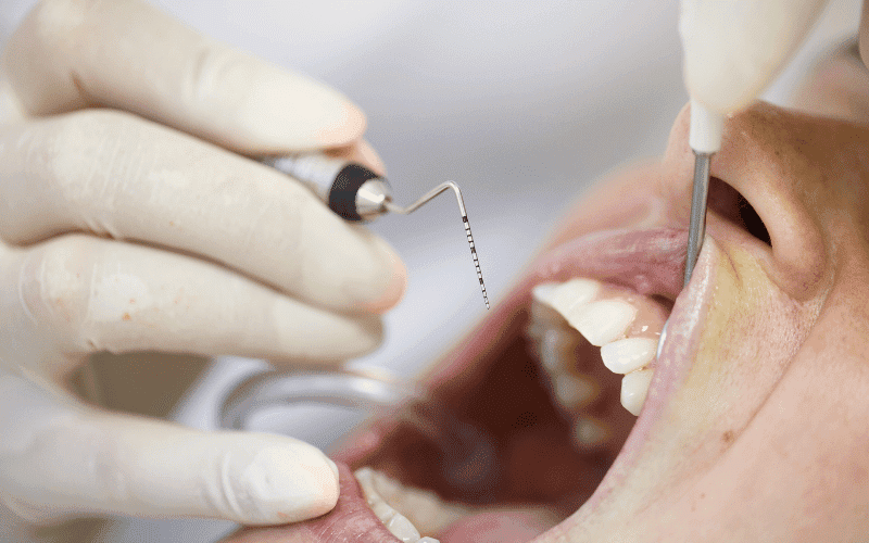 Featured image for “Twinlight Periodontal Treatment for Severe Gum Disease”