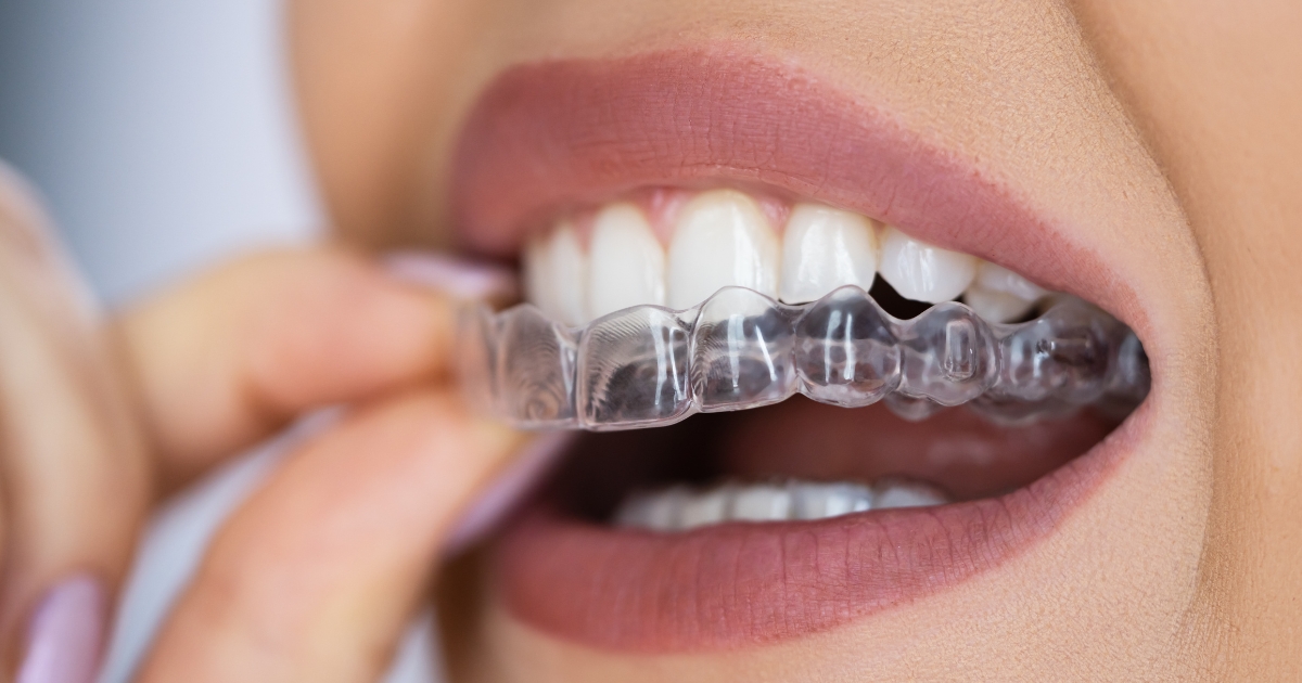 Featured image for “How Can Clear Aligners Address Complex Orthodontic Issues?”