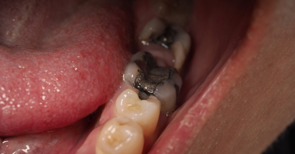 Featured image for “Is A Black Tooth An Emergency?”