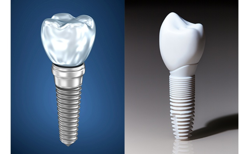 Featured image for “Why Zirconia Implants Are A Game Changer For Patients With Metal Allergies?”