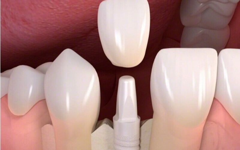Featured image for “Top 10 Common Questions About Zirconia Dental Implants”