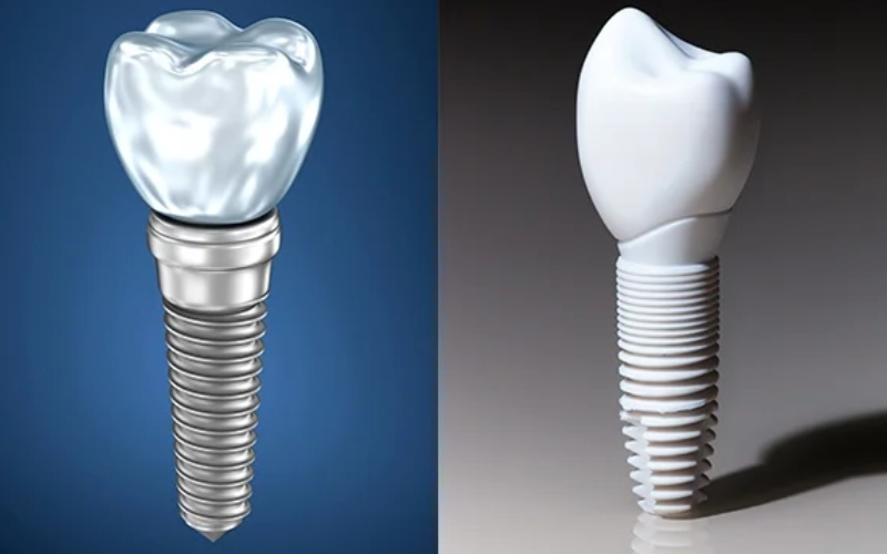 Featured image for “Why Are Metal-Free Dental Implants The Best Choice?”